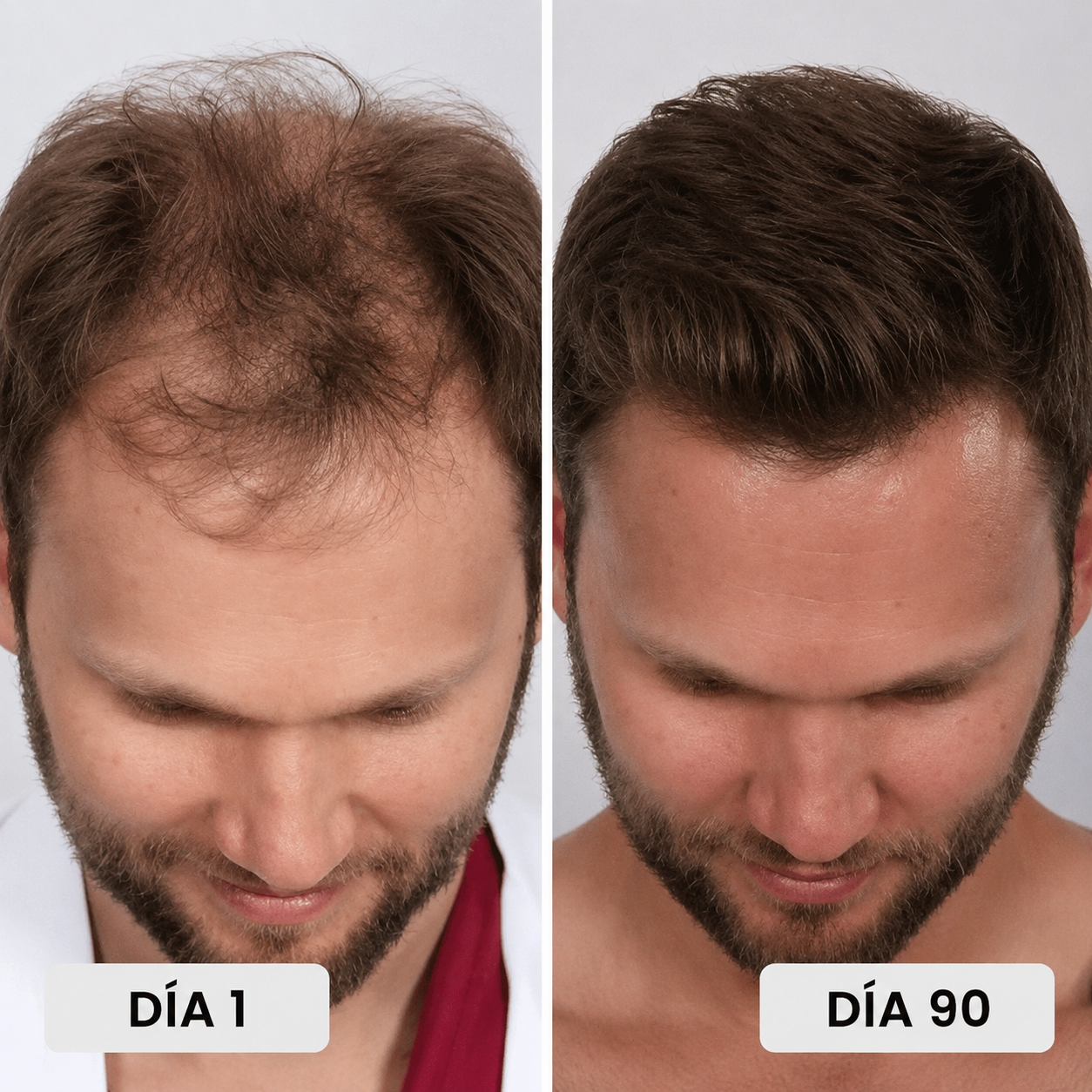 Gorro Renacer Capilar® de luz roja para fortalecer el cabello desde la raíz