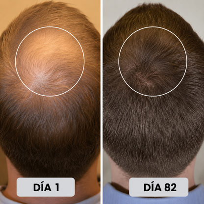 Gorro Renacer Capilar® de luz roja para fortalecer el cabello desde la raíz